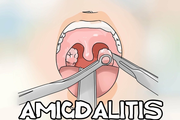 Amigdalitis