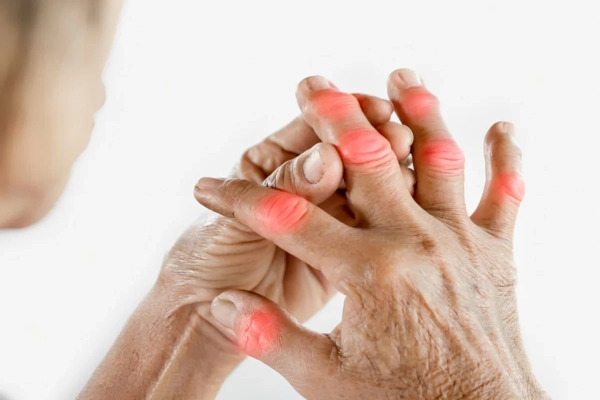 Artritis Reumatoide