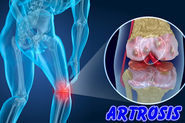 Artrosis