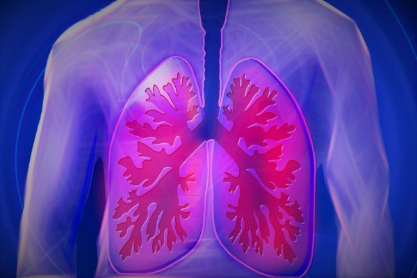 Asbestosis