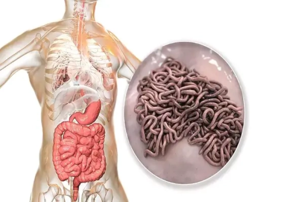 Ascariasis