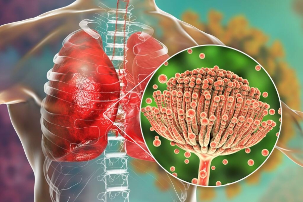 Aspergilosis