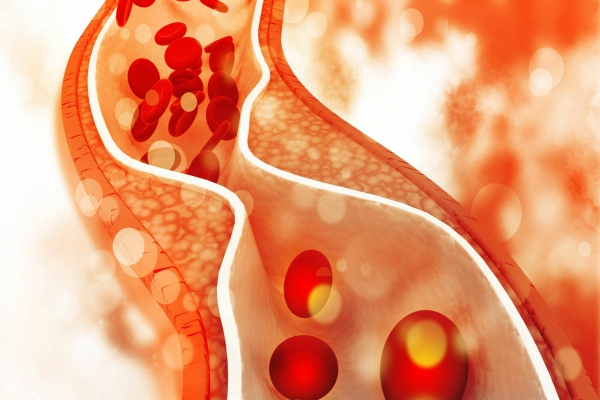 Aterosclerosis