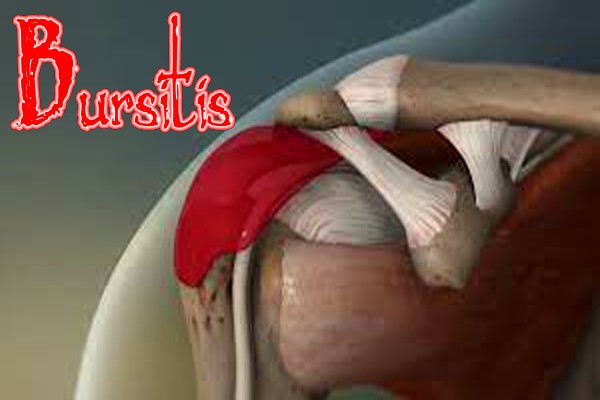 Bursitis
