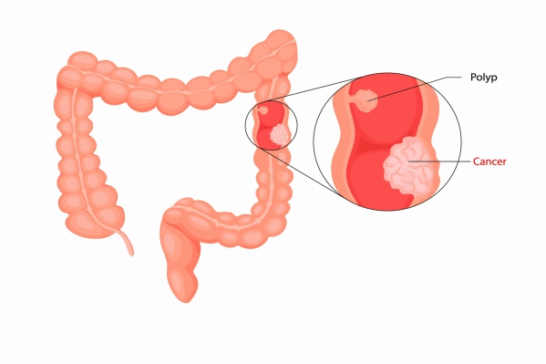 Cáncer de colon