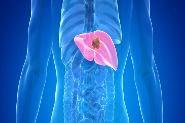 Cáncer de hígado