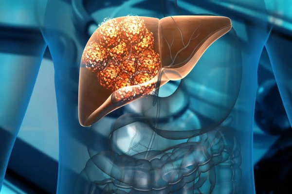 Cáncer de Hígado: