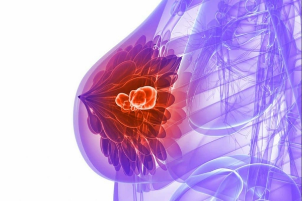 Cáncer de mama