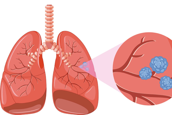 Cáncer de riñón