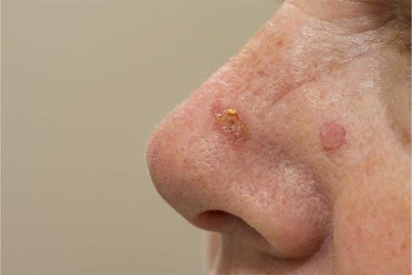 Carcinoma