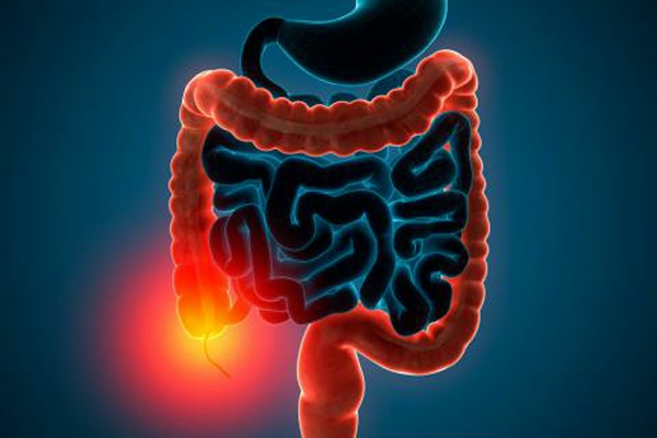 Colitis Ulcerosa