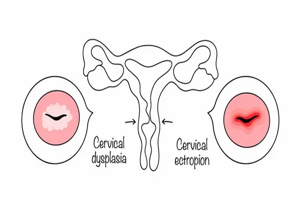 Displasia cervical