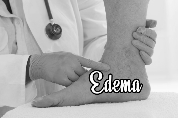 Edema