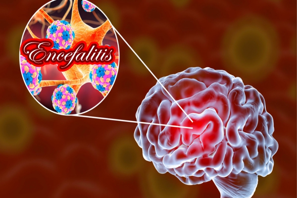 Encefalitis