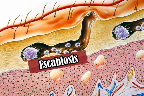 Escabiosis