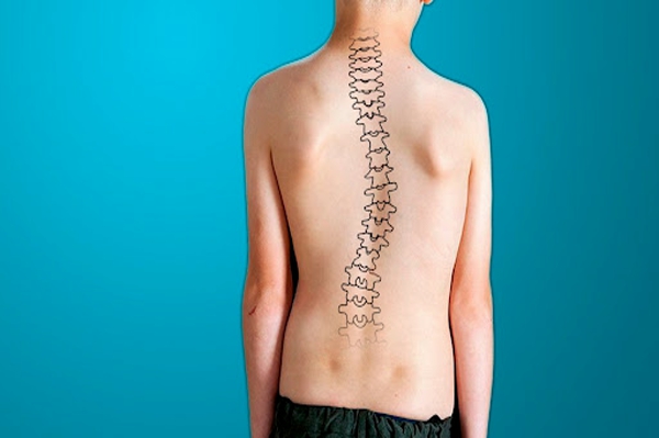 Escoliosis