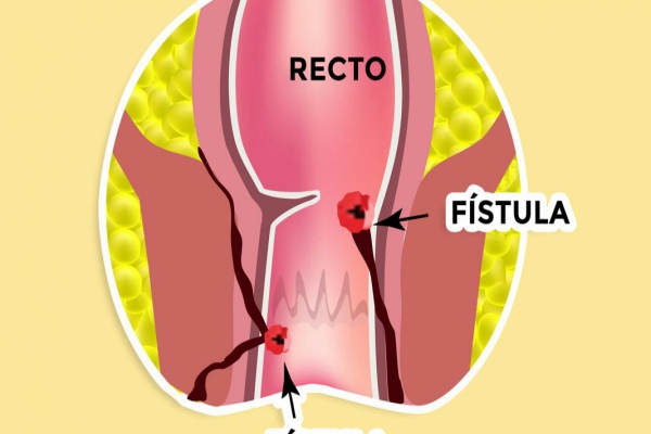 Fístulas