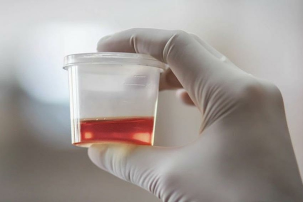 Hematuria
