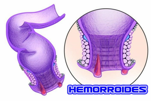 Hemorroides