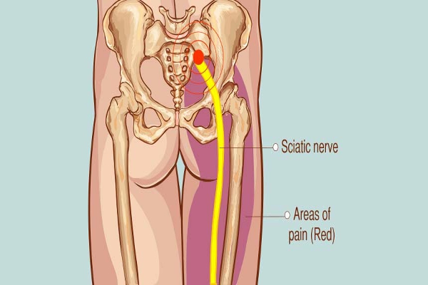 Hernia ciática
