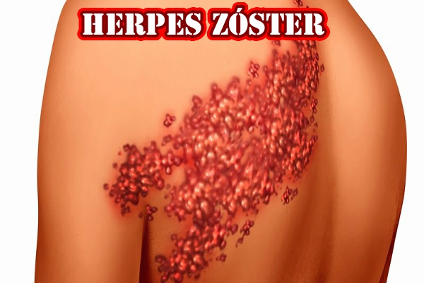 Herpes zóster