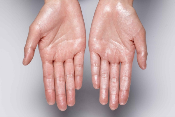 Hiperhidrosis