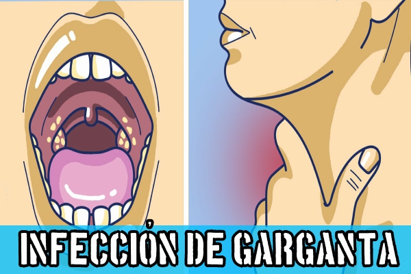 Infección de garganta