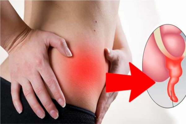 La apendicitis