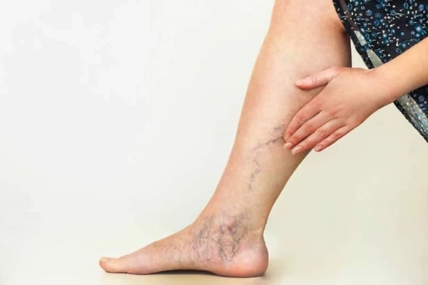 Las varices