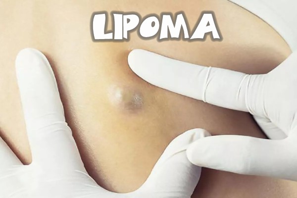 Lipoma