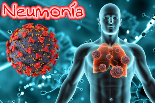 Neumonía