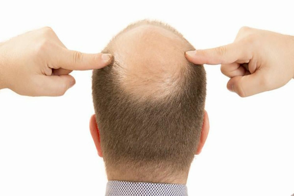 ¿Qué es la alopecia?
