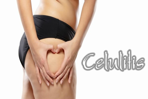 ¿Qué es la celulitis?