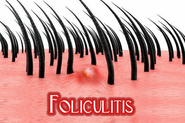 ¿Qué es la foliculitis?