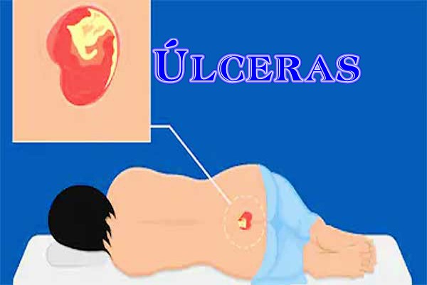¿Qué es una úlcera?
