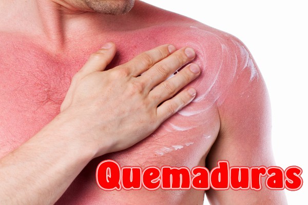 Quemaduras