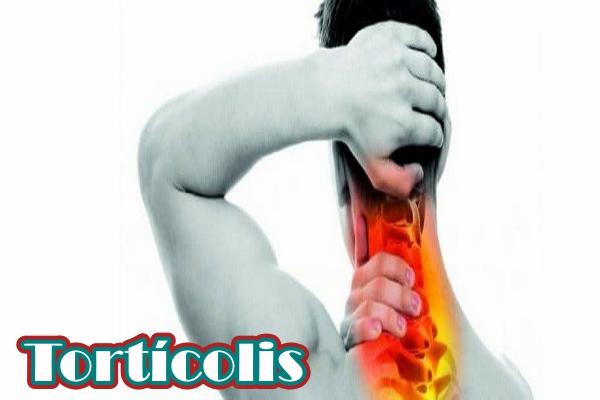 Tortícolis