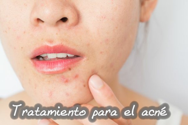 Tratamiento para el acné