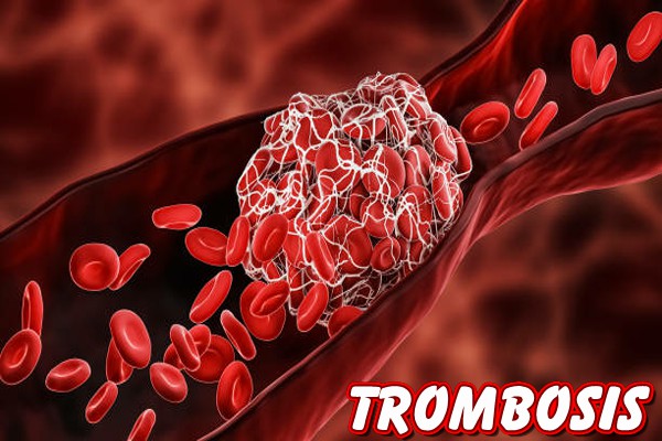 Trombosis