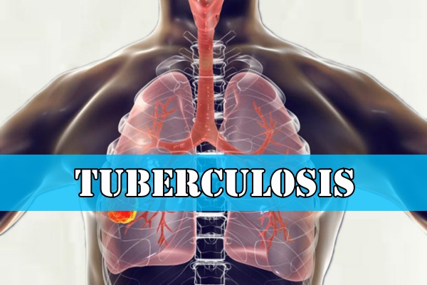 Tuberculosis