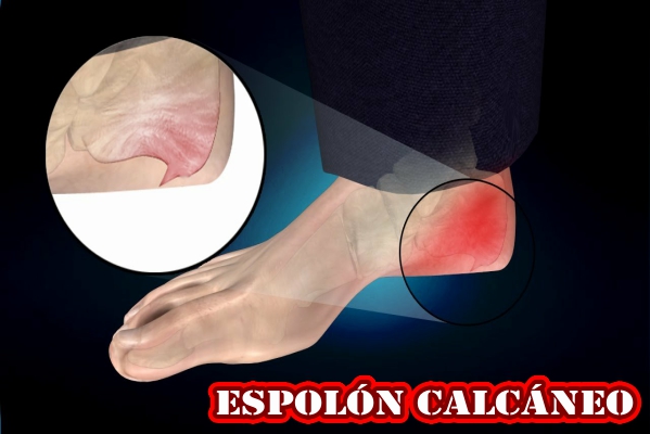 Espolón calcáneo - Integral Medical Clinic